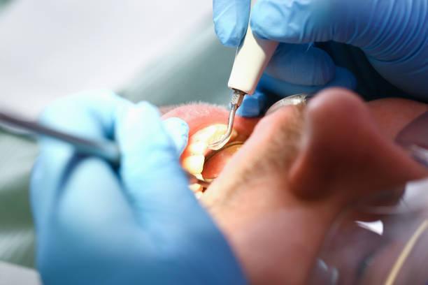 Best Emergency Root Canal Treatment in Erlanger, KY
